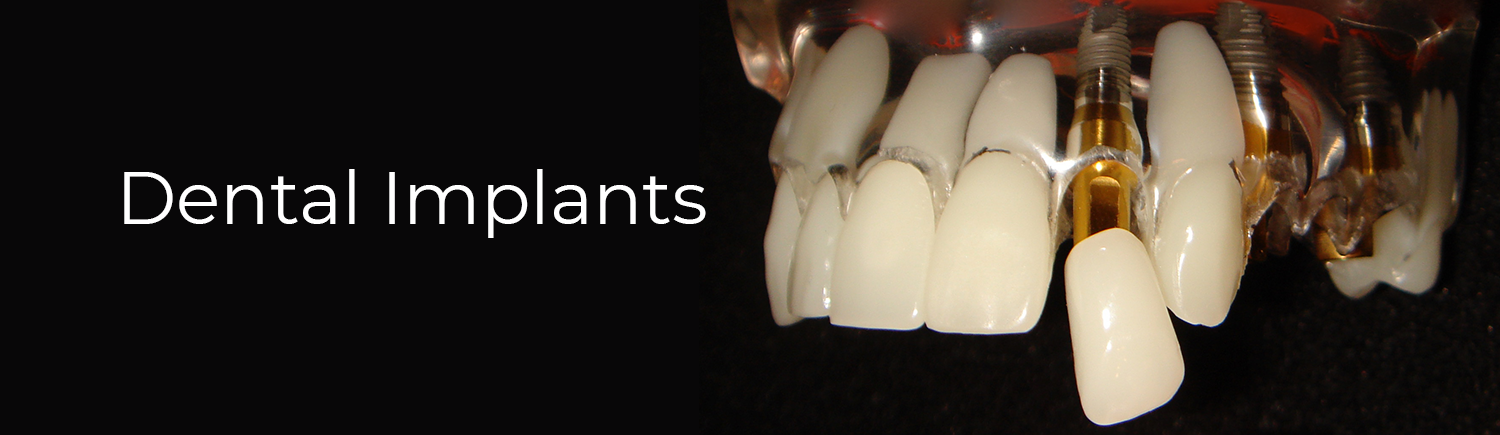 dental implants